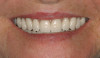 Figure 10  Square Form , Complete maxillary and mandibular dentures. .