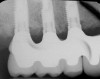 Figure 12  Square-Tapering Form, Complete maxillary and mandibular dentures.