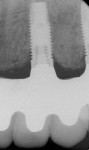 Figure 14  Radiographs of edentulous maxilla: dental implant fixed partial denture.