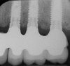 Figure 14  Ovoid Form, Complete maxillary denture and mandibular implant overdenture.