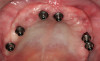 Figure 19  The neck of the tooth should be slightly depressed.