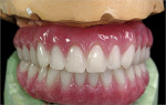 Figure 16  Finished ISUS hybrid denture.