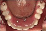 Figure 17  The hybrid denture in place.