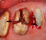 Fig 1. Trisection of a maxillary left first molar. Photograph demonstrates that from the palatal aspect, the mesial furcation is one-third of the way to the buccal, and the distal furcation is half the distance to the buccal.