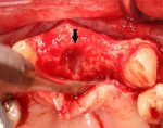 Fig 7. Nasopalatine canal, usually located palatal and in between the central incisors, contains descending palatine artery and nasopalatine nerve.