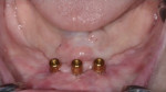 Fig 8. Placement of the 4 mm cuff height legacy LOCATOR abutments at 10 weeks.