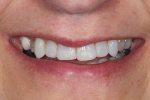Fig 2. The smile view shows the low lip line and the lingually positioned tooth No. 5.