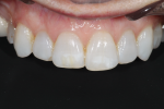 Fig 3. The retracted view shows the uneven incisal edges against black contrast and gingival levels.