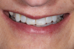 Fig 4. This tipped-down smile view shows the maxillary incisal edges short of the inner vermillion border of the lower lip.