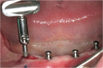 Figure 2  Four Atlas implants are installed anterior to the mental foramen. Photograph courtesy of Dr. Wolfram Bücking.