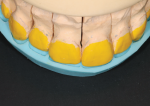 Fig 7. APM putty matrix is applied to the unprepared teeth model for space visualization.