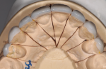 Fig 8. This occlusal view of master cast shows symmetrical balance from Nos. 5 through 12 on indirect porcelain restorations.