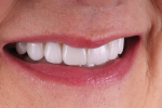 Fig 10. In this right lateral final smile photograph, the patient’s new smile exhibits
the natural esthetic appeal that she desired.