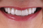 Fig 9. In this anterior final smile photograph, the patient’s new smile exhibits
the natural esthetic appeal that she desired.