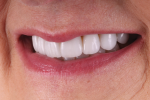 Fig 11. In this left lateral final smile photograph, the patient’s new smile exhibits
the natural esthetic appeal that she desired.