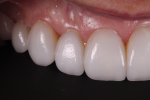 Fig 12. The lateral photographs show healthy gingival tissues, surface texture, and translucency.