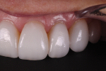 Fig 13. The lateral photographs show healthy gingival tissues, surface texture, and
translucency.