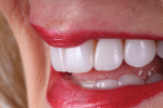 Fig 14. This lateral smile view shows the natural esthetic blend in harmony with the
lips.