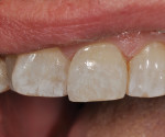 Final restoration utilizing OMNICHROMA composite restorative. Note the natural blending and color match to the adjacent tooth structure (A superfine placement of Tokuyama Estelite COLOR [shade: WHITE] was used to add characterization to match the slight hypocalcification of the adjacent teeth.).
