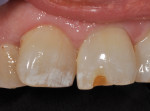 Preoperative photo of 20-year-old Class IV composite, revealing material shade mismatch with moderate wear and recurrent decay on tooth No. 9.
