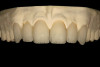 Figure 5  BLEACHING PROCEDURE  Instruct the patient to close onto their back teeth, and create suction with their lips.