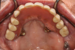 Occlusal view of the maxillary hybrid prosthesis. Note the pterygoid implant emerging through tissue on upper left side. The zygomatic implants assist in retaining the prosthesis but impinge on the palatal space.