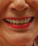 Final smile photograph showing a satisfied patient with newfound esthetics, improved comfort, and elimination of infection.
