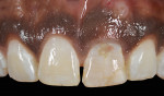 Fig 3. Intraoral view of patient with a reconstructed maxillary left central incisor that had fractured. Note fistula tract over the apex of tooth No. 9.