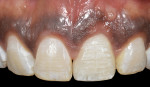 Fig 16. Six months post healing. Note the healthy tissue tone and preservation of the interdental papillae height.