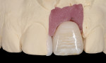 Fig 18. A no-preparation mesial-facial indirect composite veneer was made to manage the space discrepancy between the two central incisor teeth and close the diastema between them.