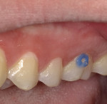 Fig 3. After the bevel was completed, the preparation was selectively etched at the periphery of the enamel using 35% phosphoric acid (Ultra-Etch™, Ultradent Products, Inc, ultradent.com) for 15 seconds and rinsed with water.