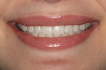 Fig 12. At 1-week postoperative, the patient had the smile that both she and the clinician were hoping for, demonstrating excellent color match and beautiful esthetics.
