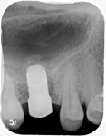 Fig 7. Periapical radiograph demonstrated the radiopaque appearance of the fully seated healing abutment and the graft material apical to the implant.