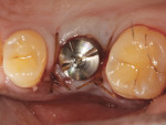 Fig 6. A BellaTek Encode Healing Abutment was placed into the implant, and the soft tissues were closed with interrupted chromic gut sutures.