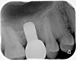 Fig 12. Radiographic verification at the final occlusal check appointment at 8 weeks post-restoration.