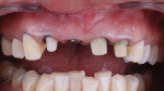 Fig 7. With the A.R.T. technique complete, final preparation of the tooth structure was achieved. Build-ups were completed on teeth Nos. 7, 9, and 10 and an impression (SplashMax®, DenMat) captured.