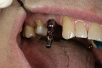 Figure 1  Open-tray impression head placed on a single implant in the arch awaiting impression taking.
