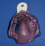 Figure 4  Superior surface of the Miratray after removal of the long pin from the open-tray impression after removal from the oral cavity.
