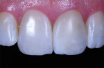 Postwhitening reevaluation showing cut back needed for tooth No. 9.
