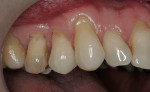 Figure 1  As enamel rods flake away, dentin is exposed and continues to receive the focused flexural stress, creating the V- or wedge-shaped pattern.