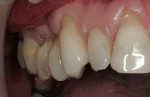 Figure 2  As enamel rods flake away, dentin is exposed and continues to receive the focused flexural stress, creating the V- or wedge-shaped pattern.