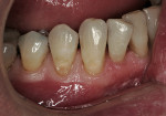 Figure 6  Caries was removed with a slow-speed round bur and all sharp line angles were smoothed and beveled.
