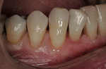 Figure 11  Two additional increments of flowable composite (shade A2) were placed in a similar fashion covering the cervical and middle thirds of the teeth.
