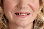 Figure 1  Before treatment with Snap-On Smile.
