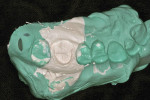 Figure 1  Prepared tooth side of the scannable Green Mousse and Mach II polyvinyl impression materials in a dual-arch tray.