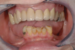 Figure 1  Pretreatment condition of patient showing loss of all mandibular posterior teeth.