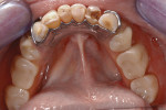 Figure 2  Existing removable partial denture with cast connector and acrylic teeth and saddles.