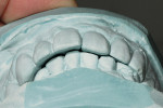 Figure 6  Articulated study models demonstrate the compensatory eruption of the worn anterior teeth.