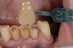 Figure 9  Photos taken with shade tabs communicate the dentin shade to the ceramist at the laboratory.