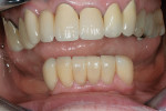 Figure 12  Definitive lithium-disilicate ceramic veneers (IPS eMax) bonded with light-cured resin cement.